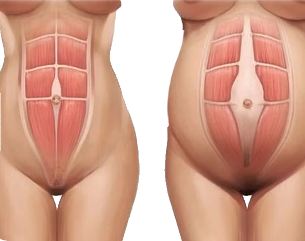 Diástasis abdominal